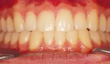 Austin after Smile Express Treatment