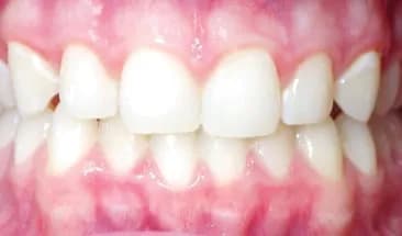 Denise after Smile Express Treatment
