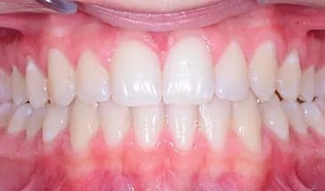 Jerrod after Smile Express Treatment