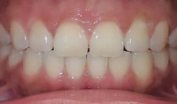 Larry after Smile Express Treatment