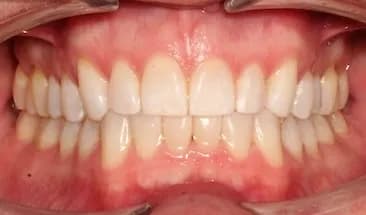 David after Smile Express Treatment