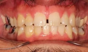 Juan before Smile Express Treatment